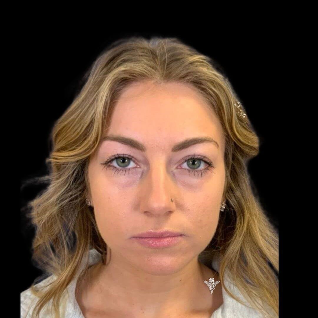 Fillers for Tear Trough Before