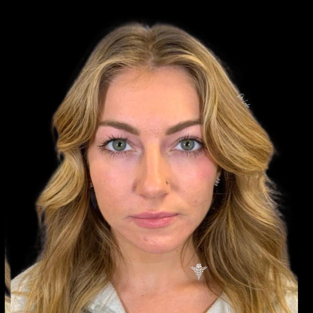 Fillers for Tear Trough After