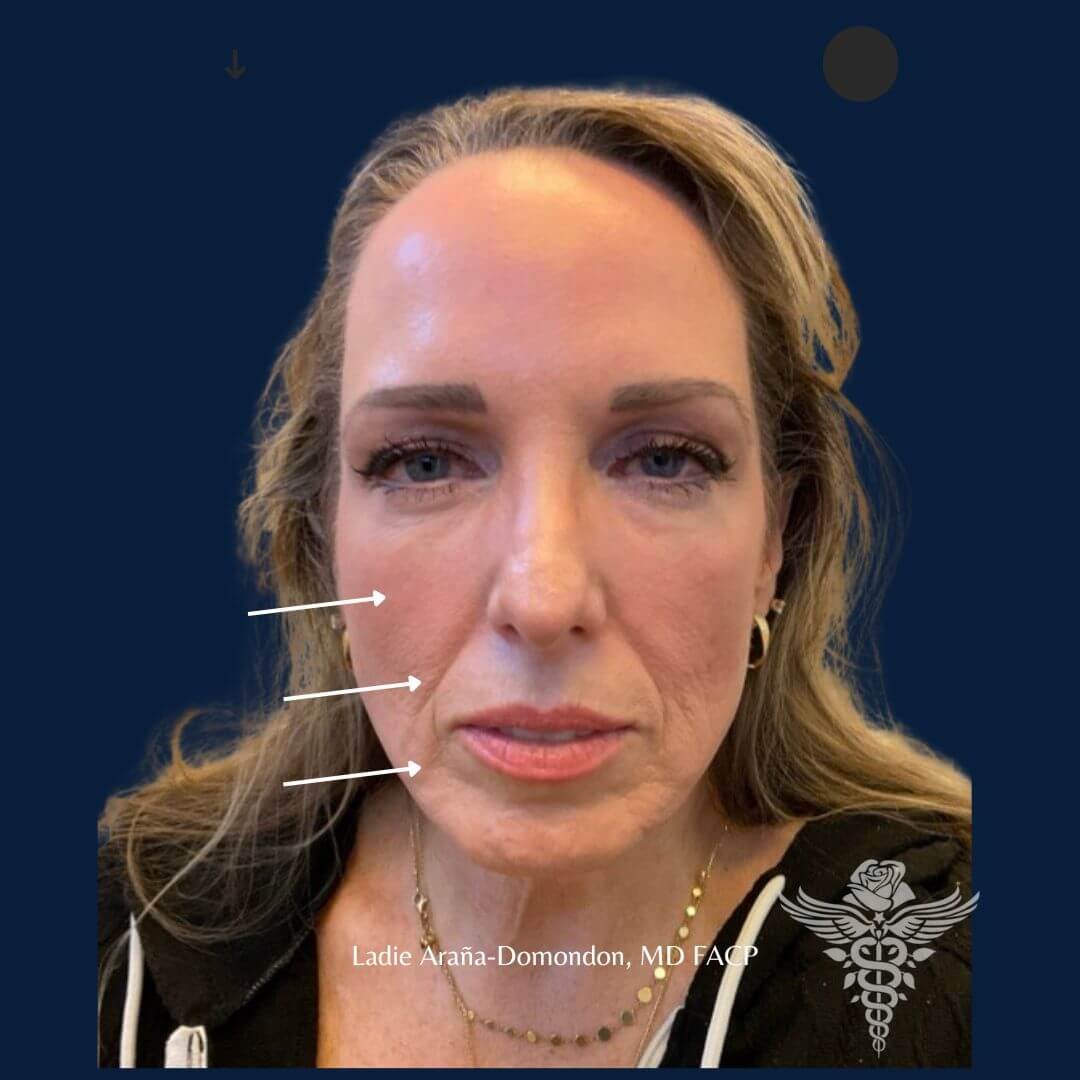 Filler Contour Lift Before