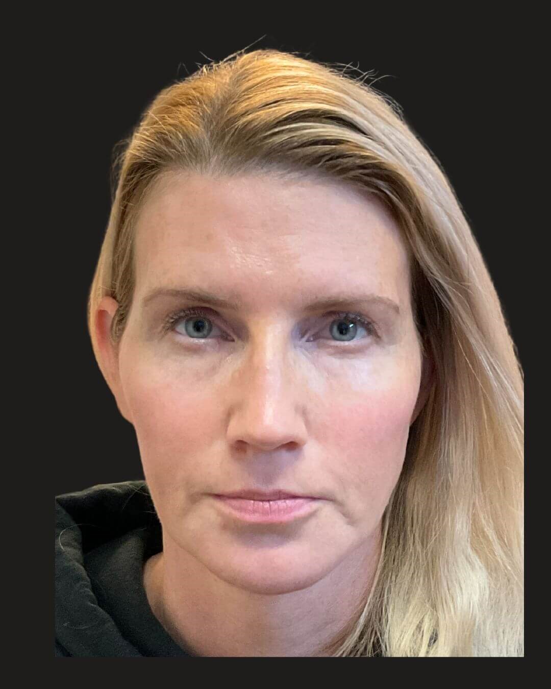 Halo Laser Treatment + BBL After
