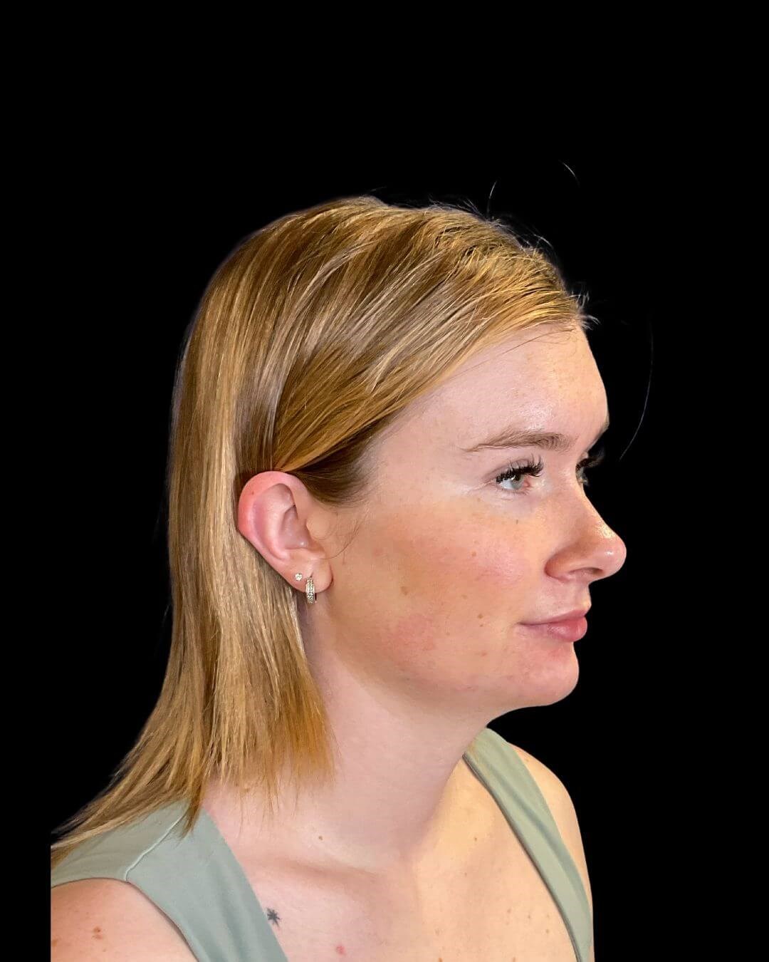 FACIAL BALANCING After