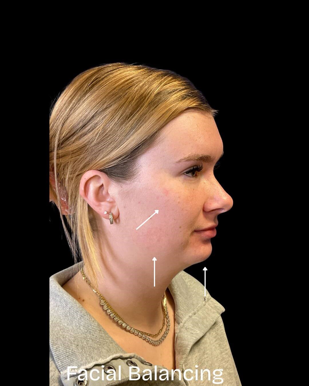 FACIAL BALANCING Before