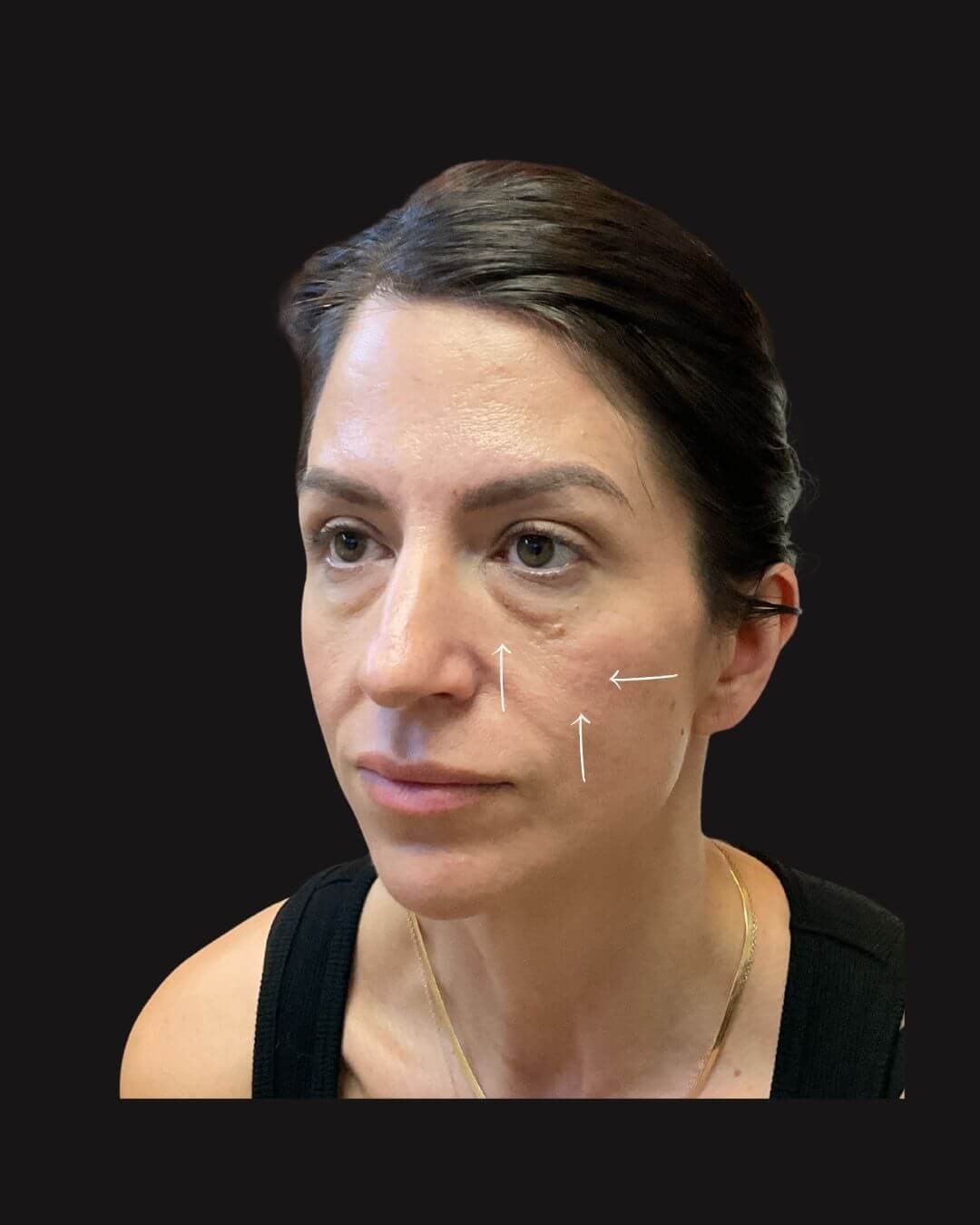Filler Contour Lift Before