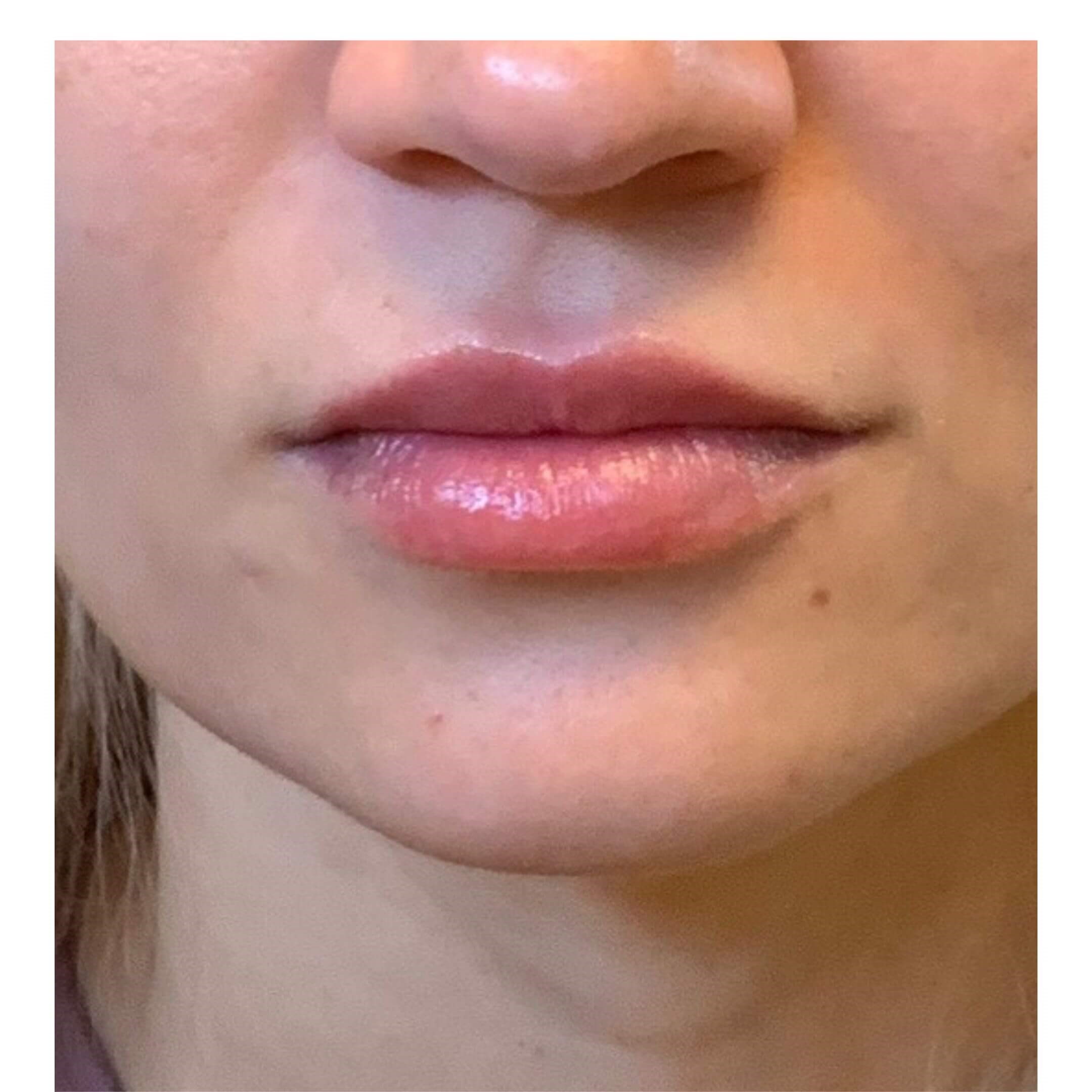 Lip Shaping After