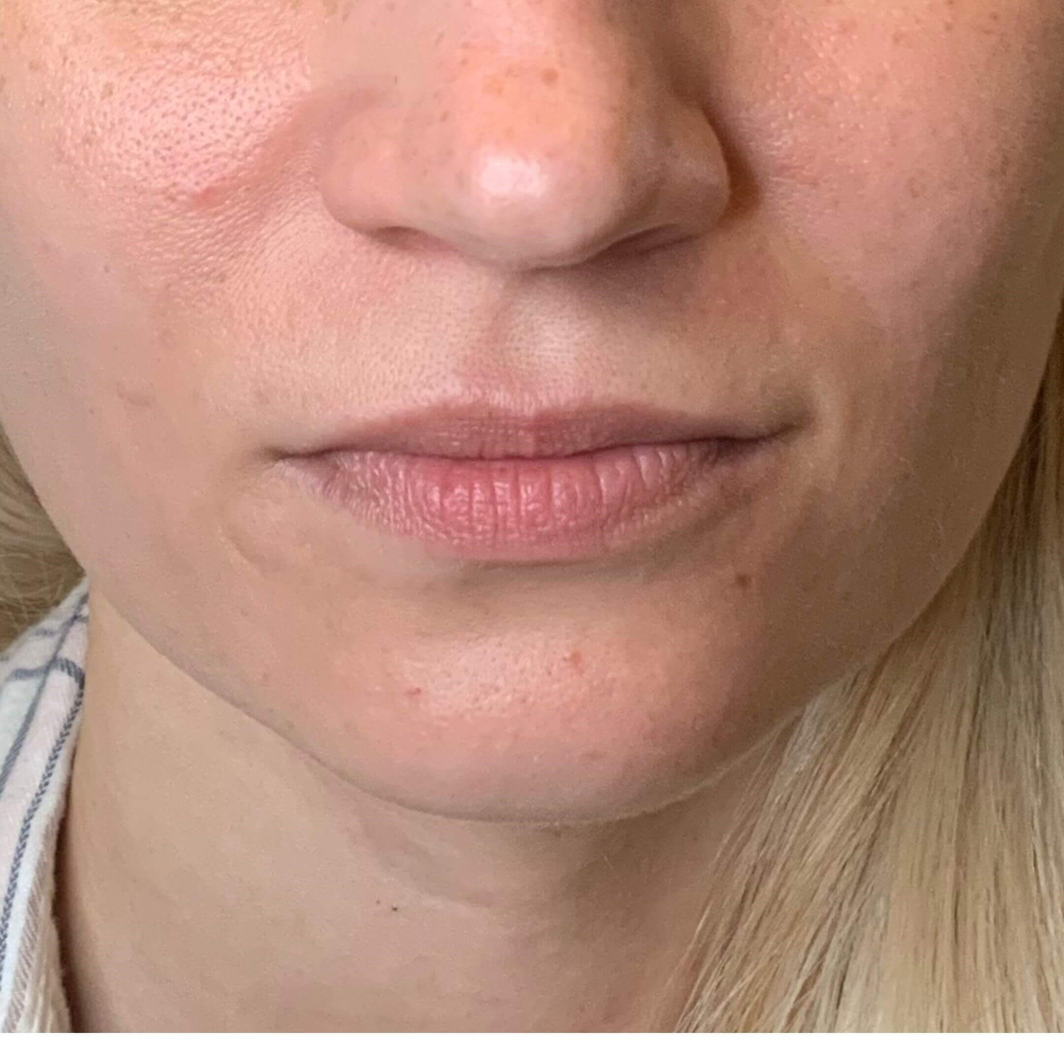 Lip Shaping Before