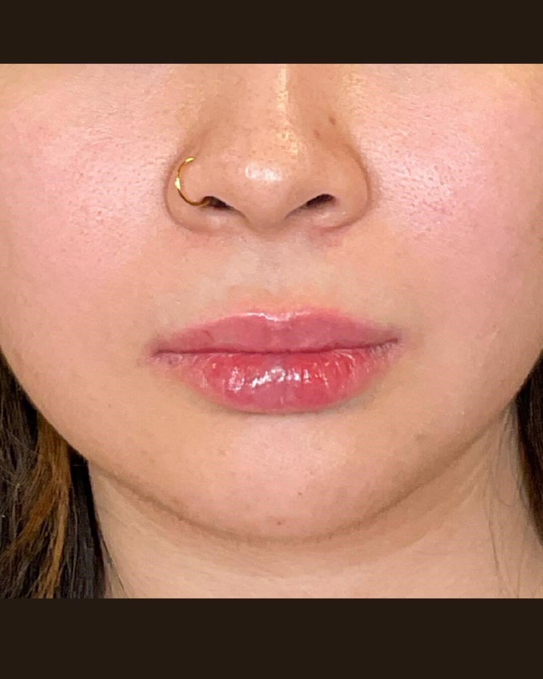 Lip Shaping After