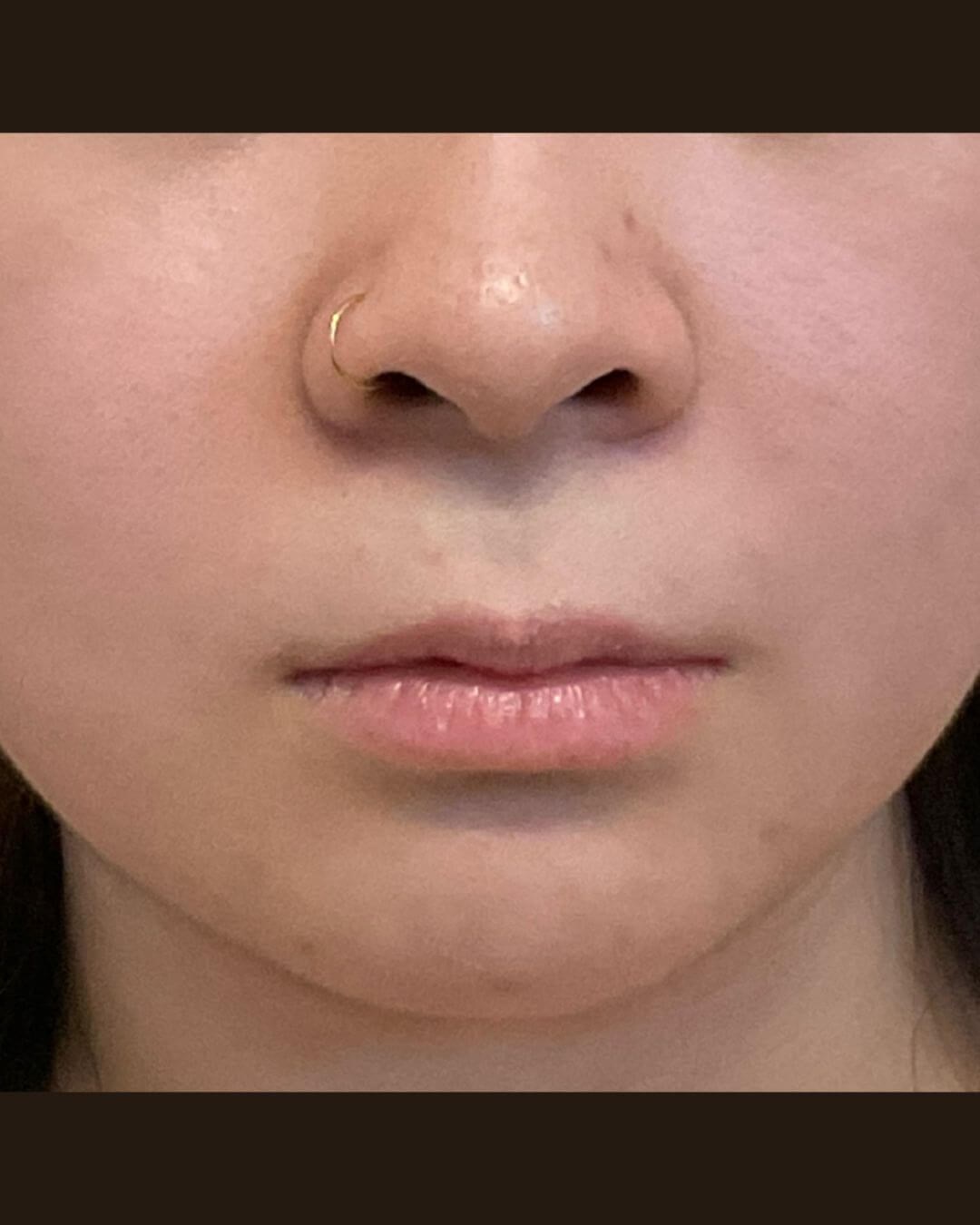 Lip Shaping Before