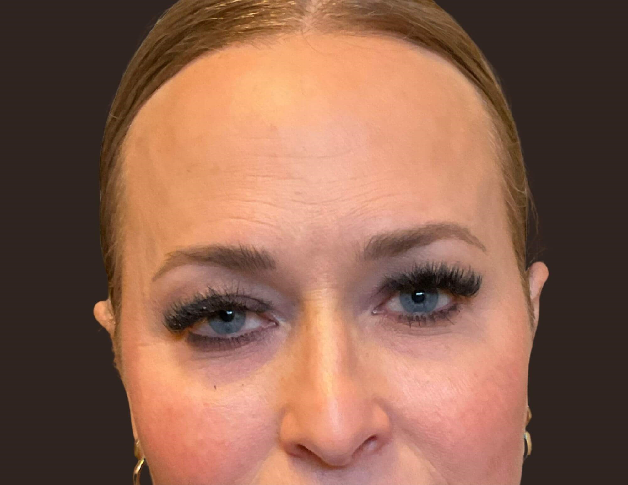 Under Eye Hollows Before