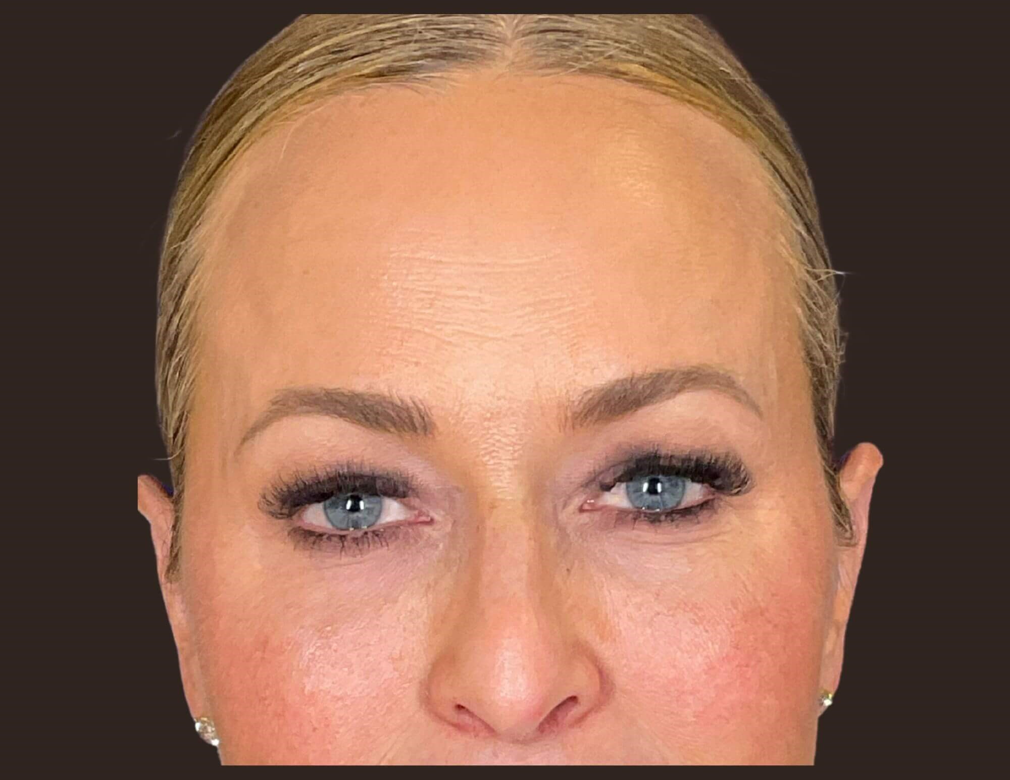 Under Eye Hollows After