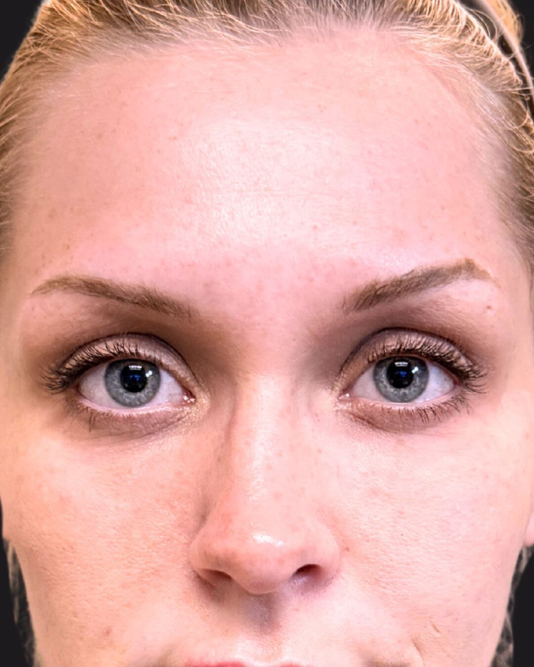 Under Eye Rejuvenation After