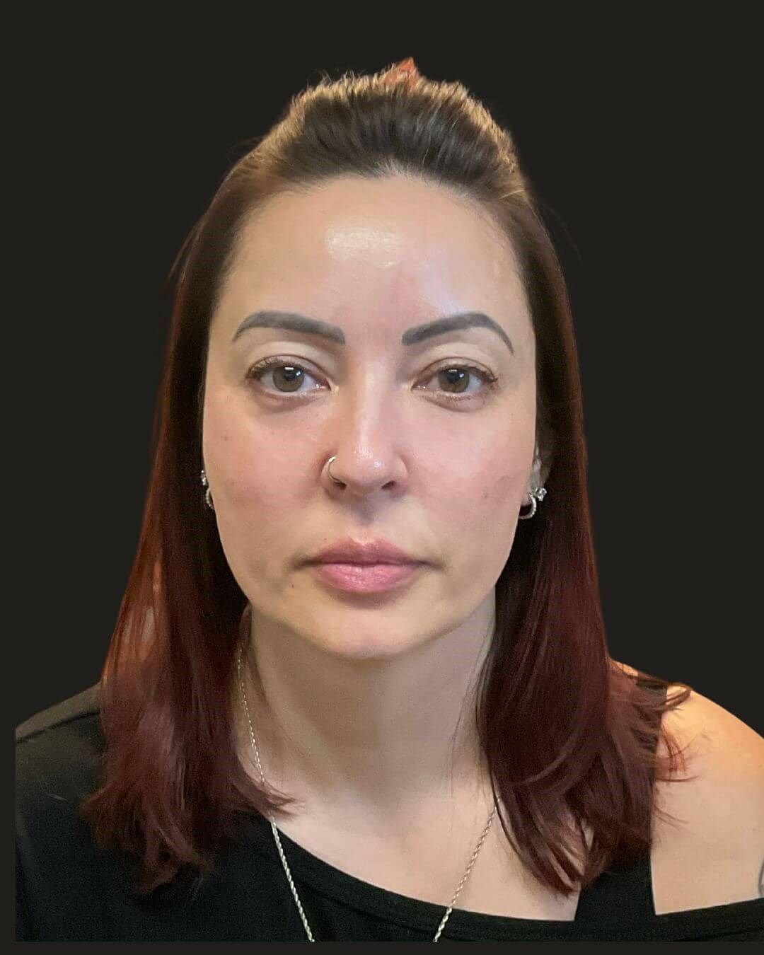 Midface Rejuvenation After