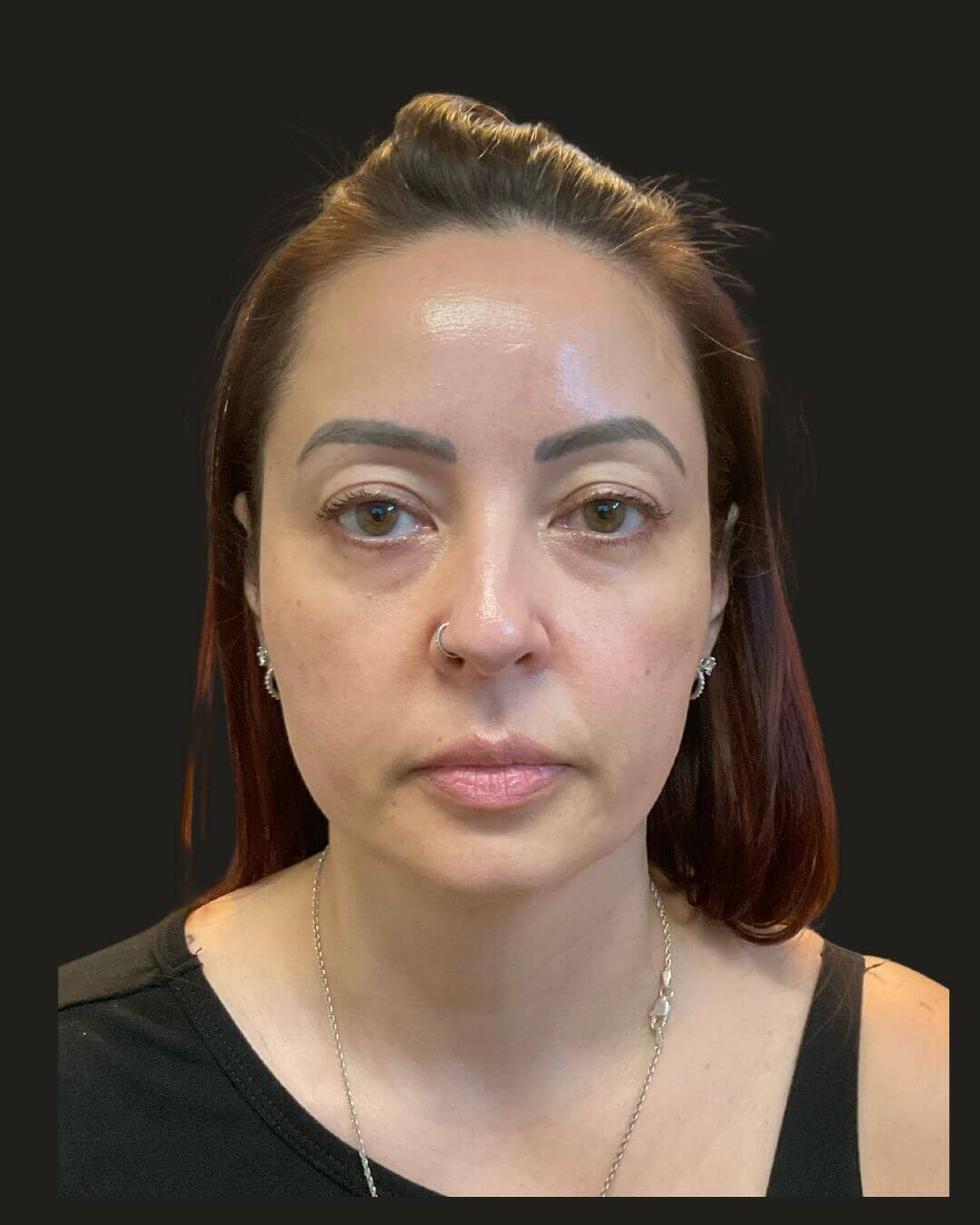 Midface Rejuvenation Before