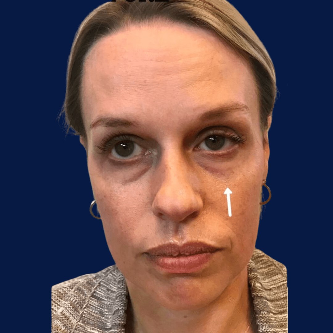 Tear Trough & Midface Filler BEFORE