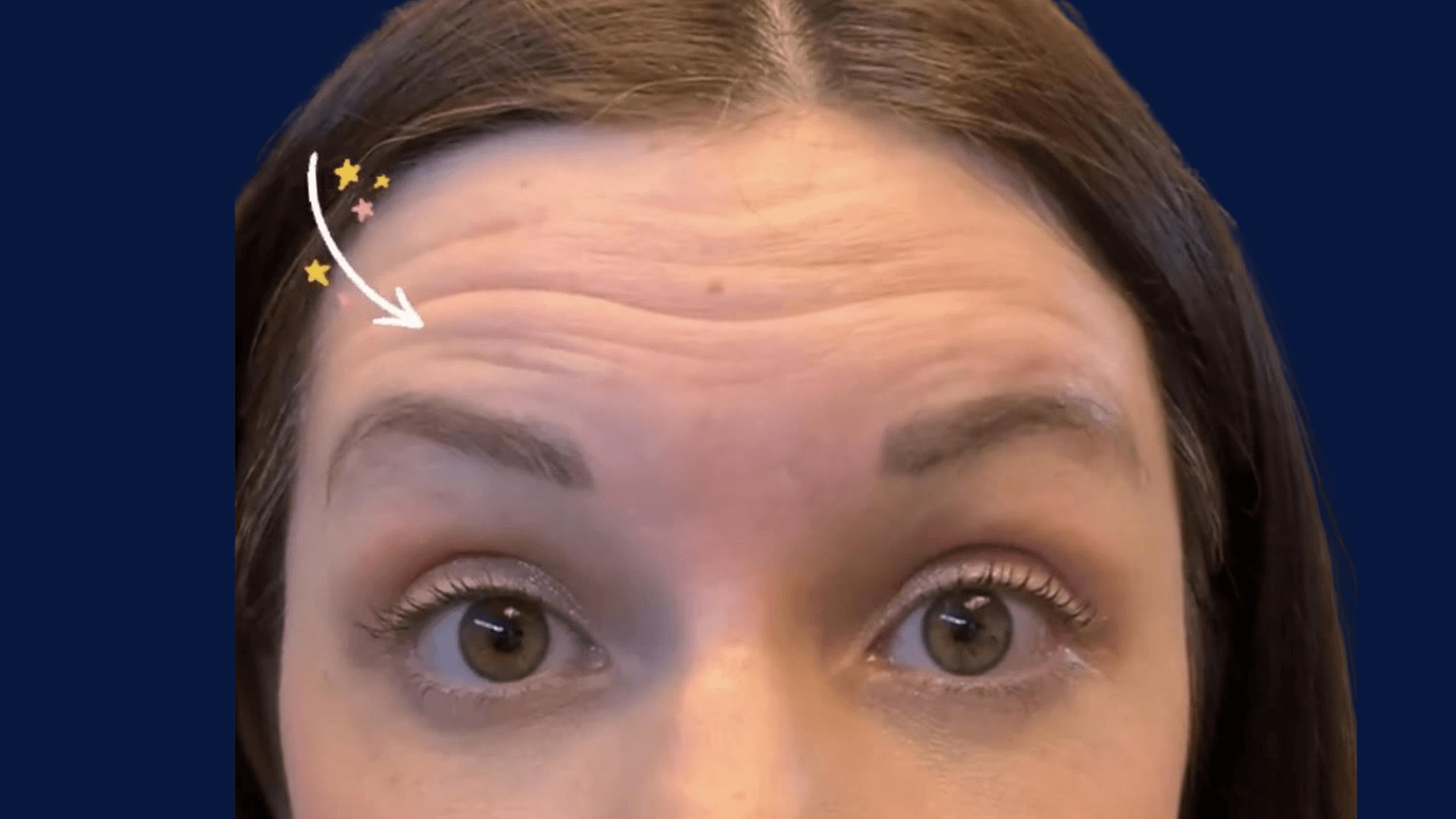 Botox Dysport for Wrinkles BEFORE