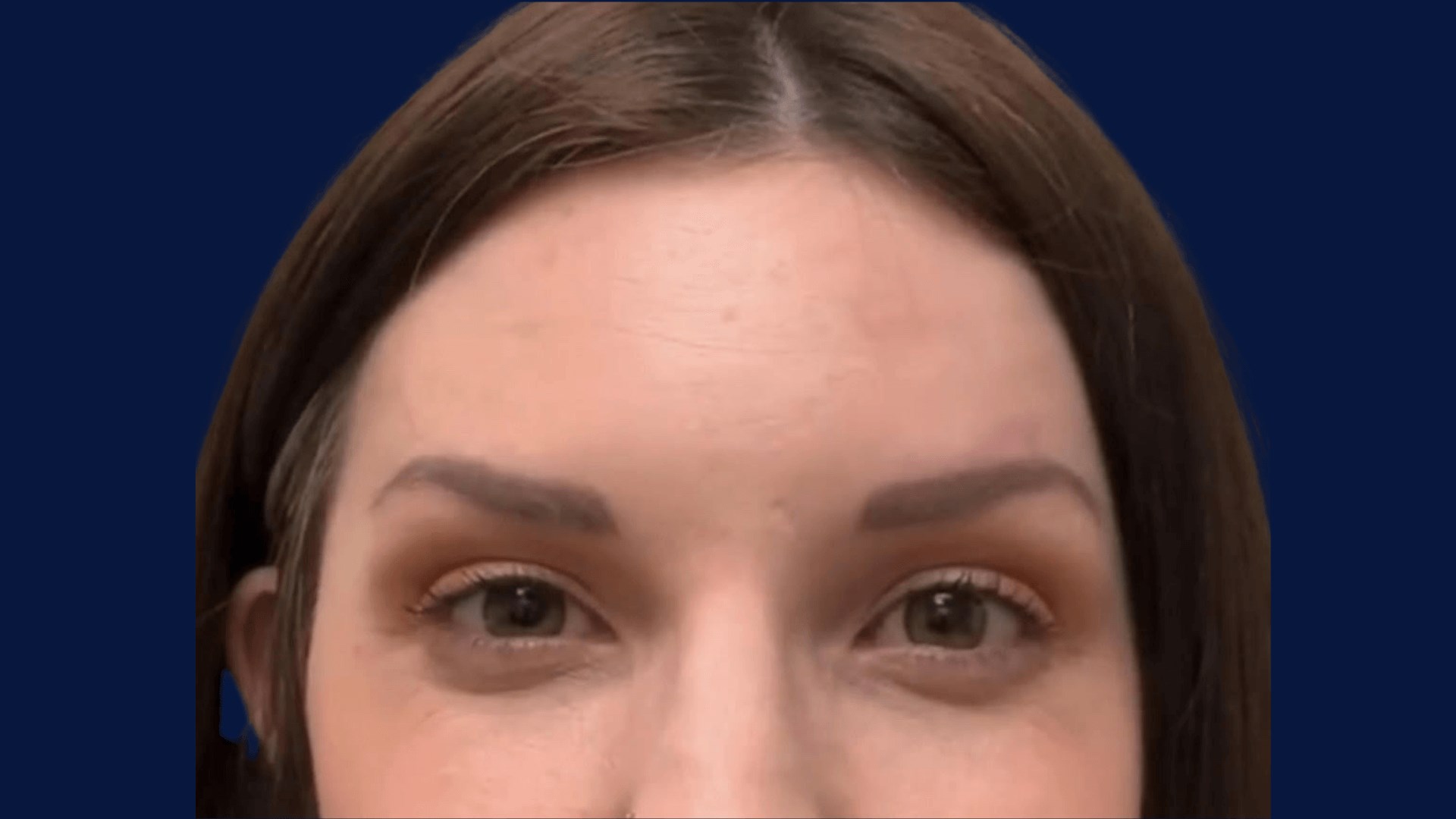 Botox Dysport for Wrinkles AFTER
