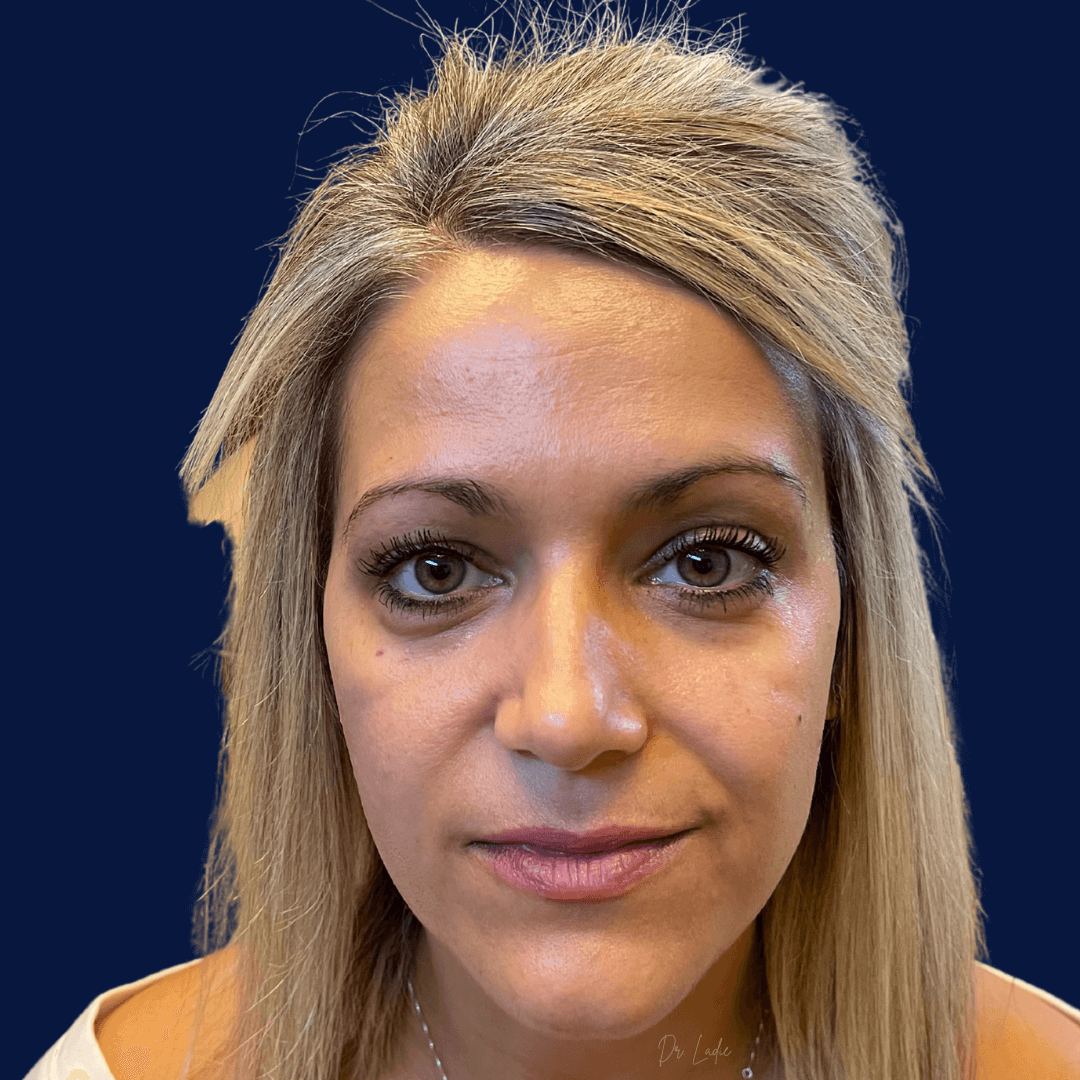 Non Surgical Face Lift BEFORE