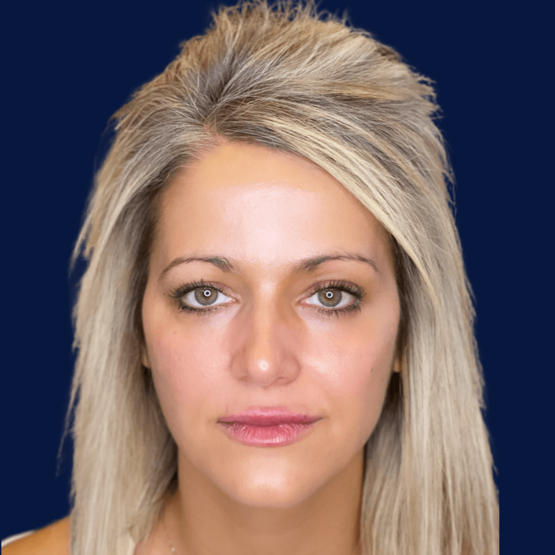 Non Surgical Face Lift AFTER