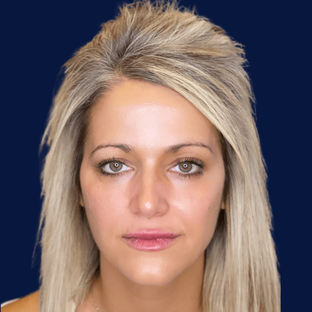 Non Surgical Face Lift AFTER