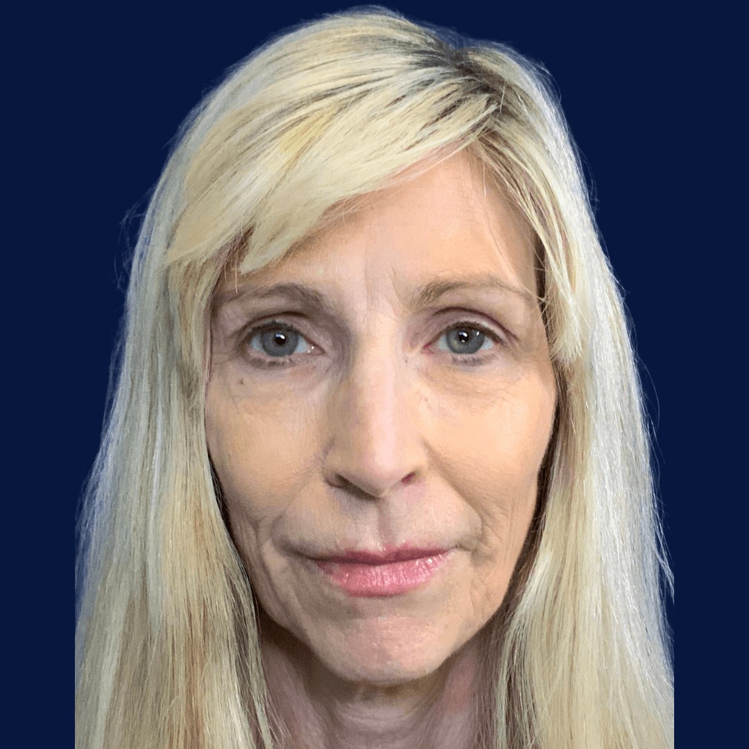 Filler Rejuvenation AFTER