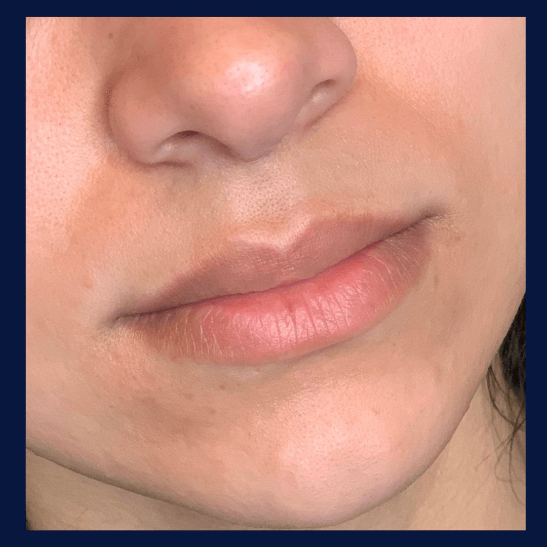 Lip Filler BEFORE