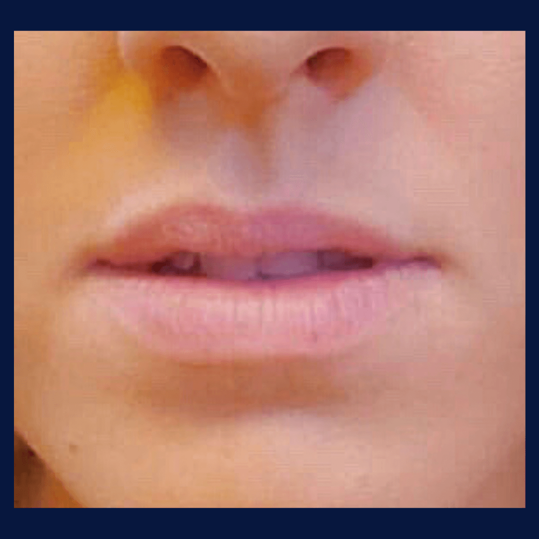 Lip Filler Before