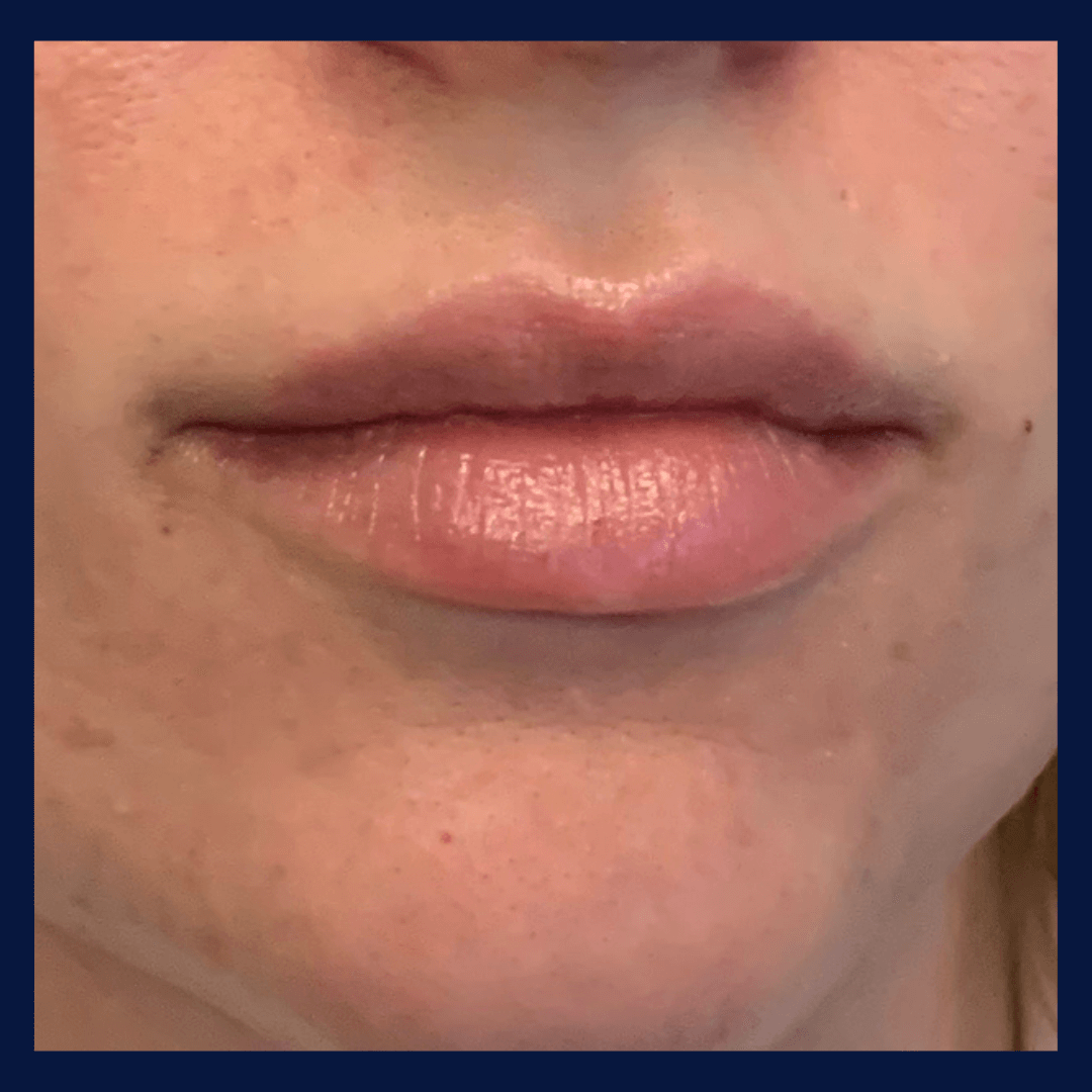 Lip Fillers BEFORE