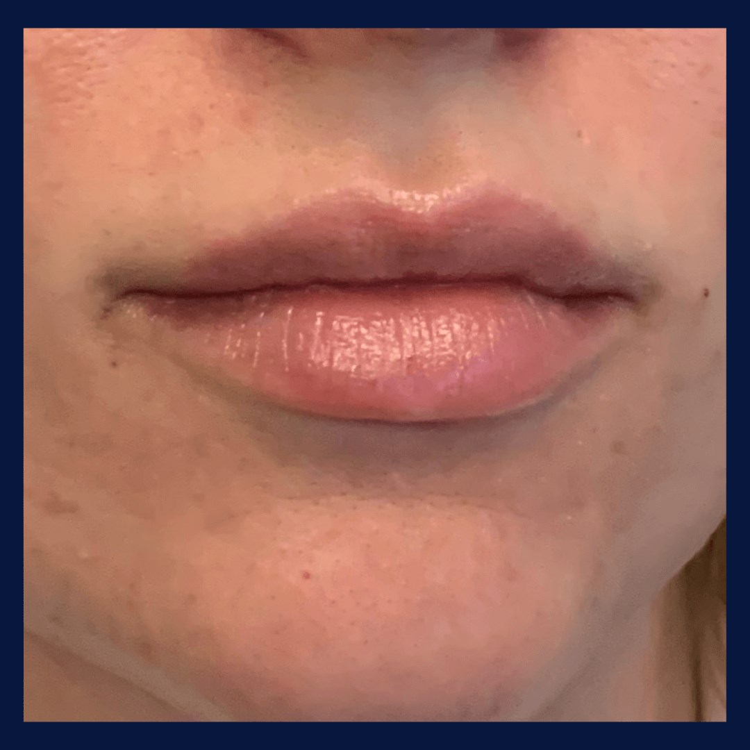 Lip Fillers BEFORE