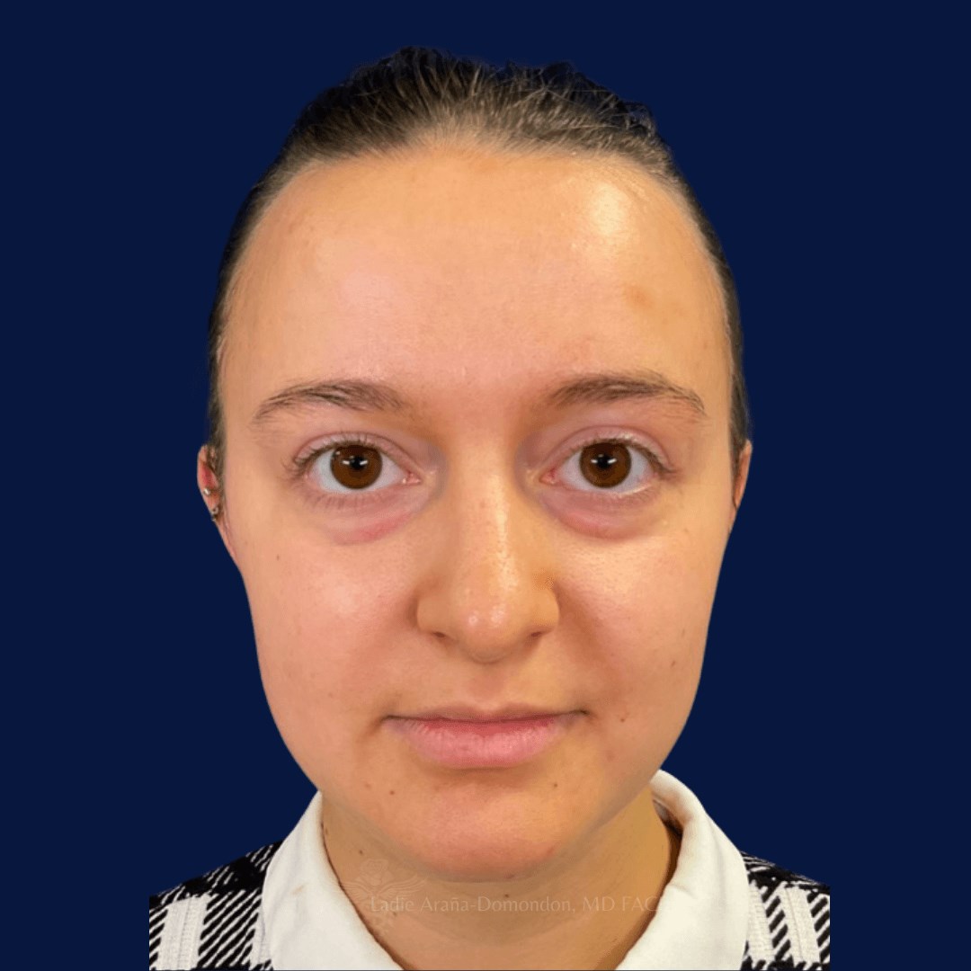 Under Eye Fillers BEFORE