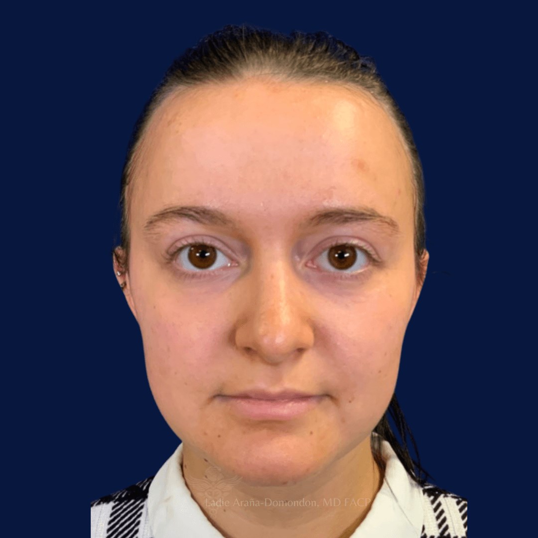 Under Eye Fillers AFTER