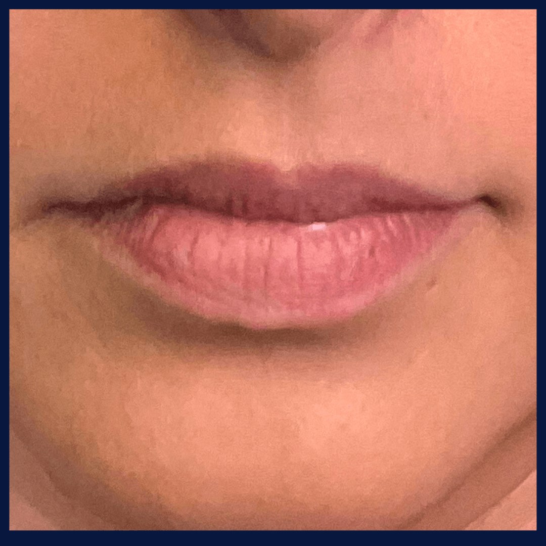 Lip Fillers BEFORE