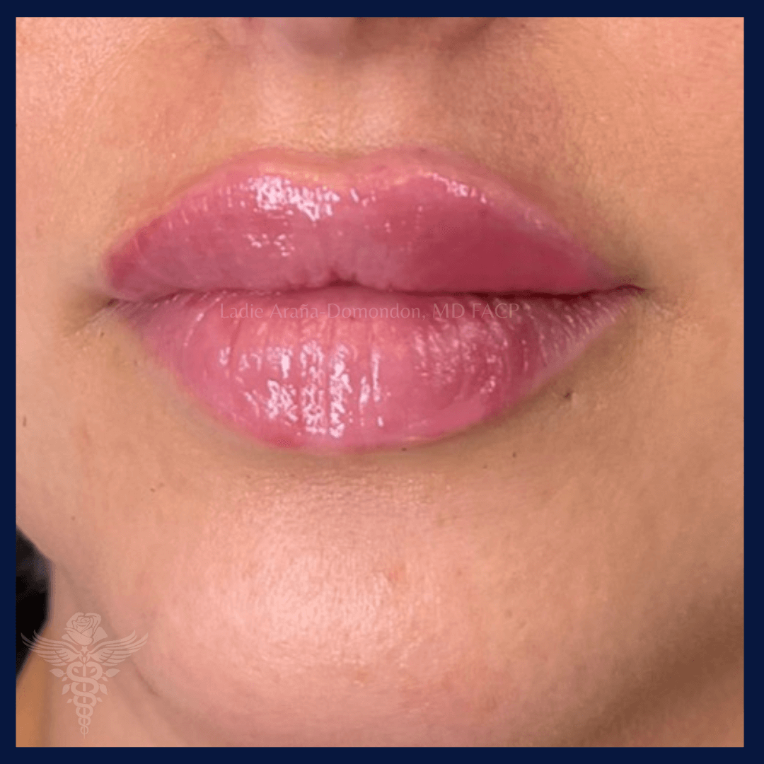 Lip Fillers AFTER