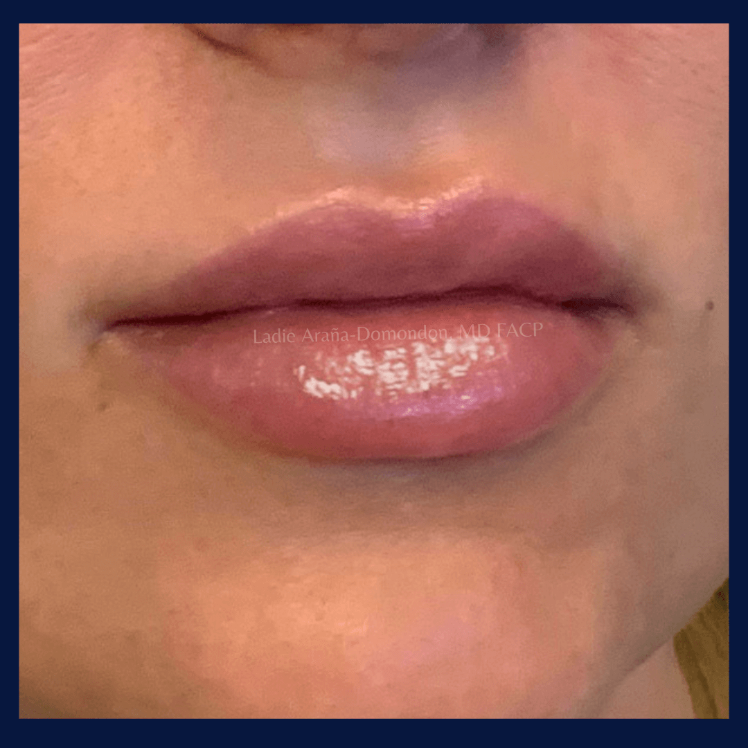 Lip Fillers AFTER
