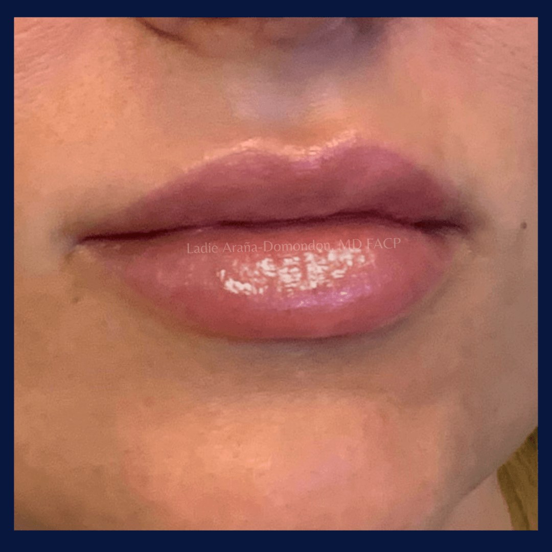 Lip Fillers AFTER
