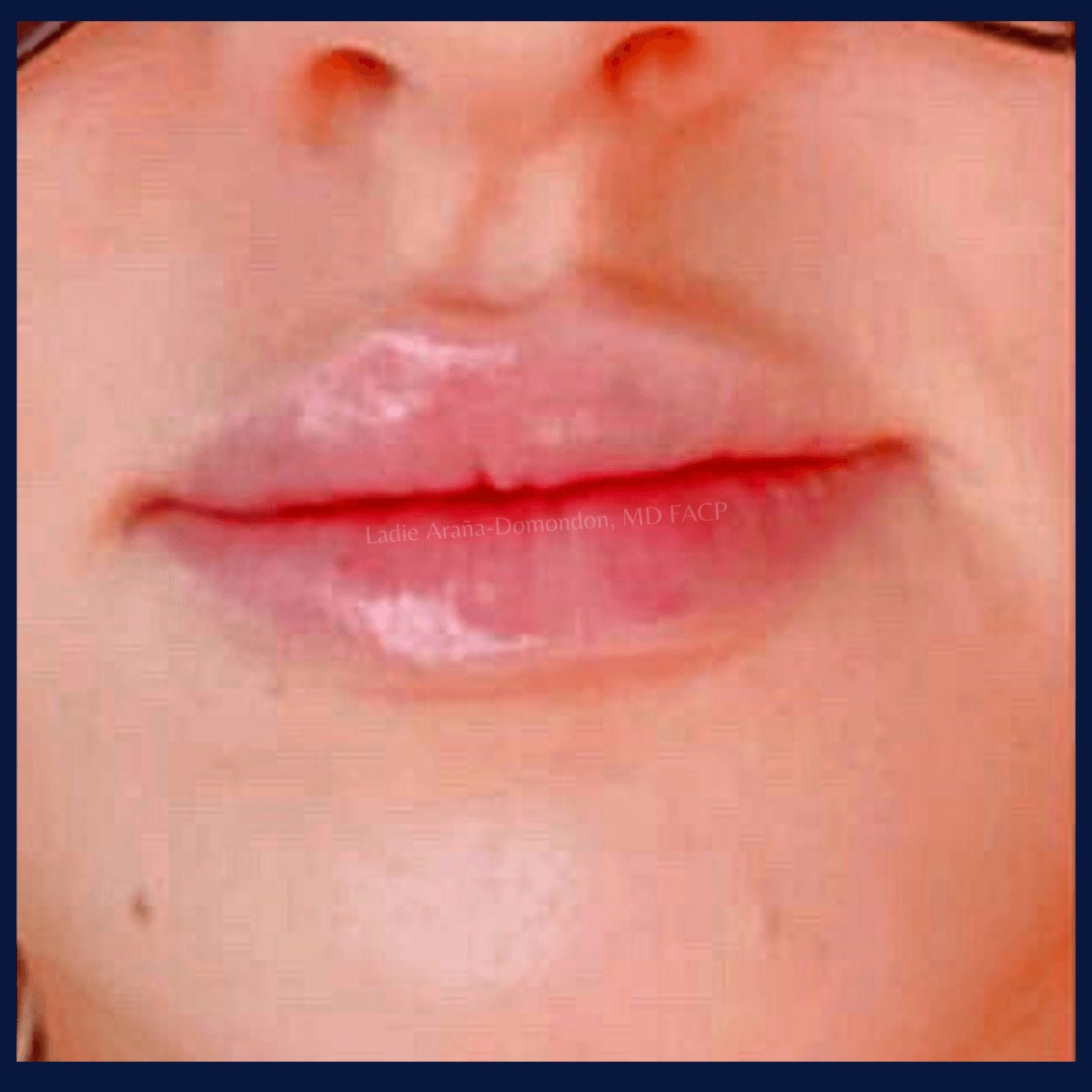Lip Filler After