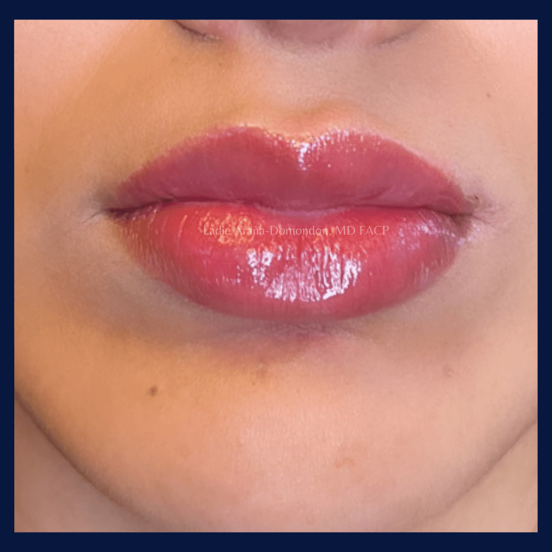Lip Filler AFTER