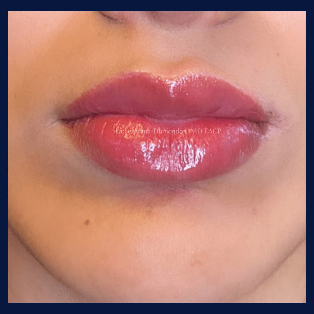 Lip Filler AFTER