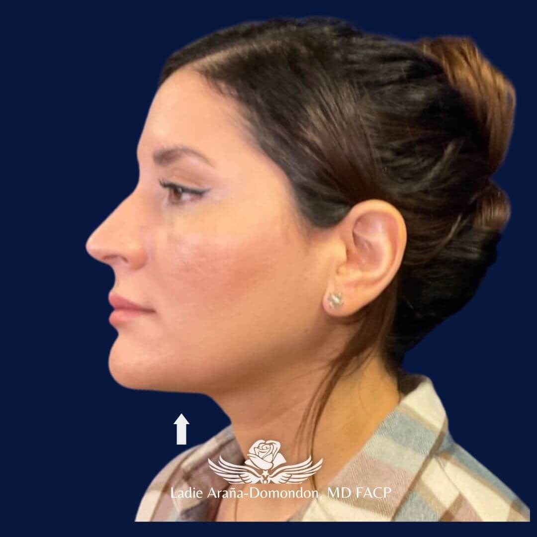 Kybella Treatment After