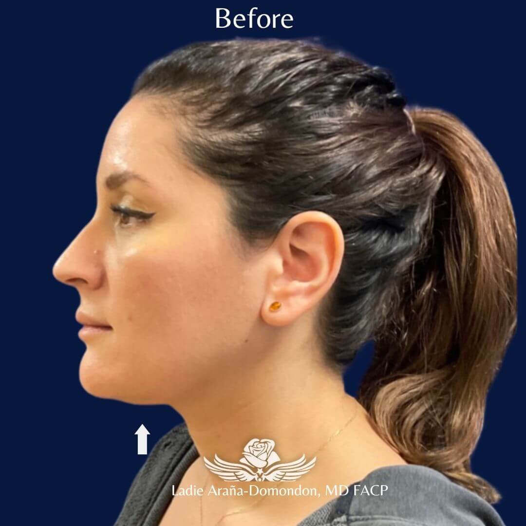 Kybella Treatment Before