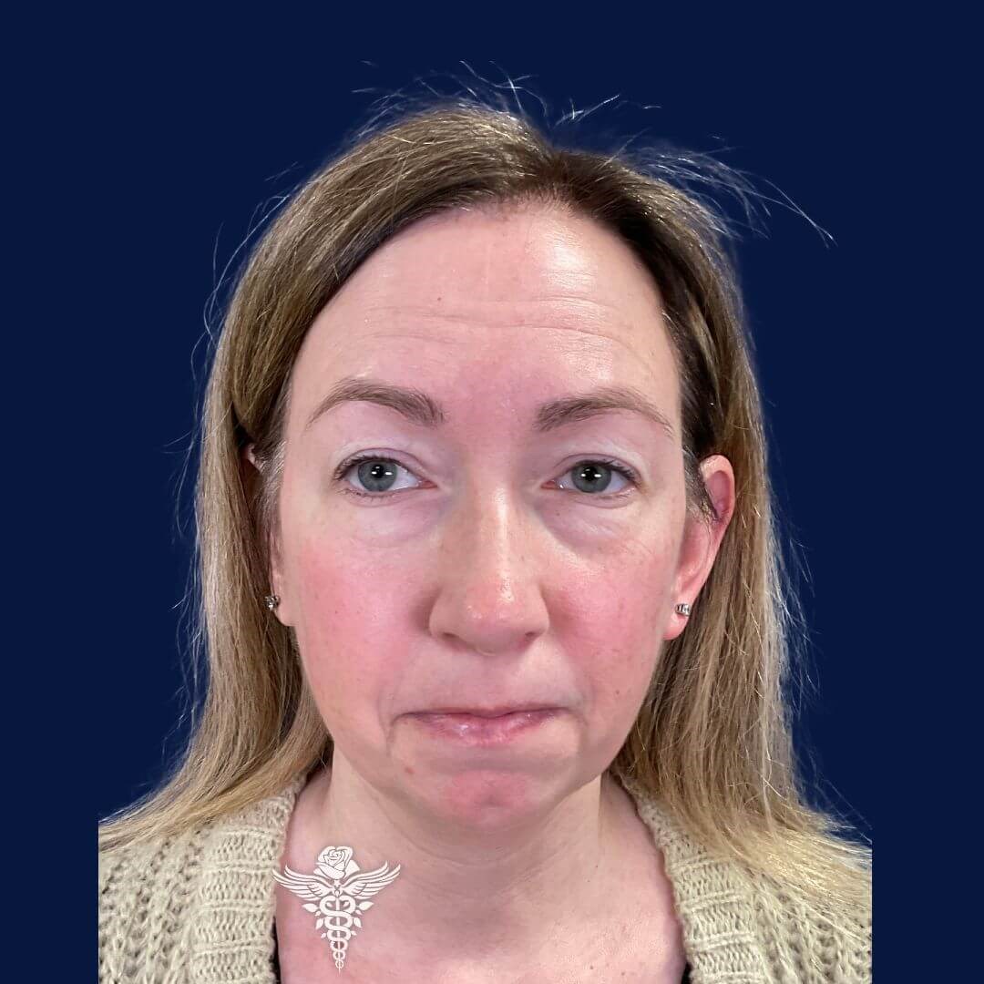 Chin Augmentation Before