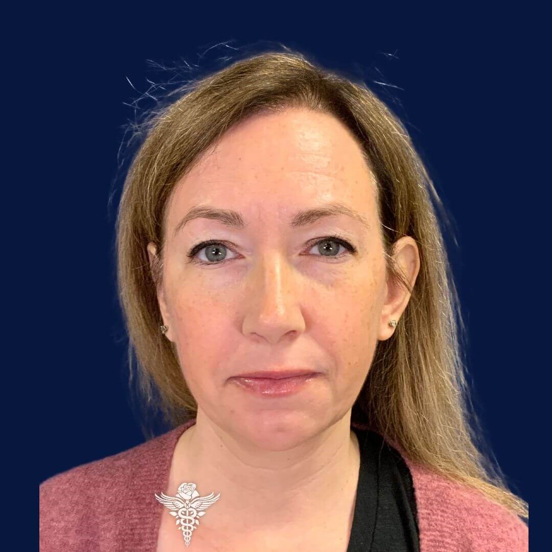 Chin Augmentation After
