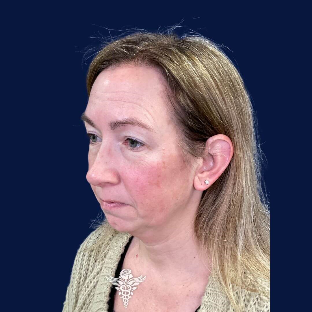 Chin Augmentation Before