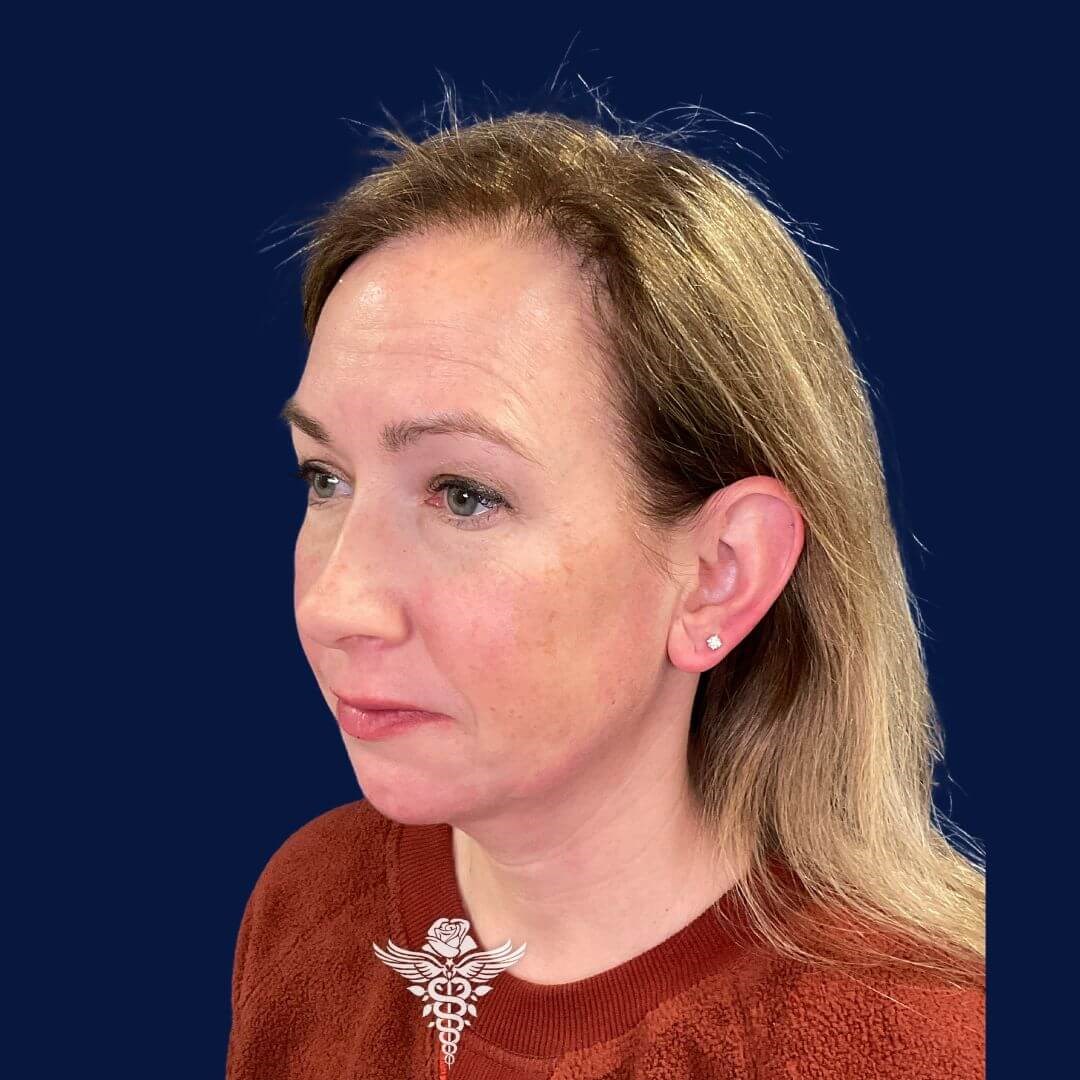 Chin Augmentation After
