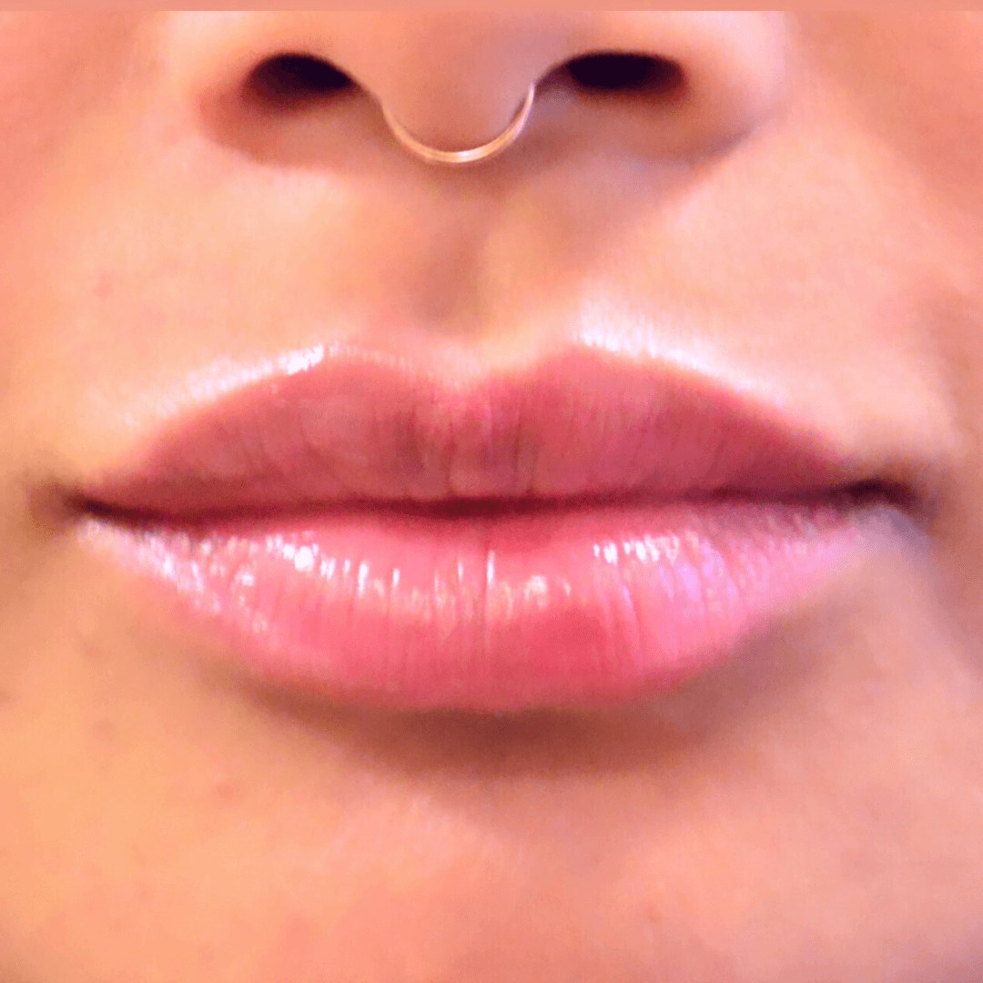 Lip Enhancement Natural look After
