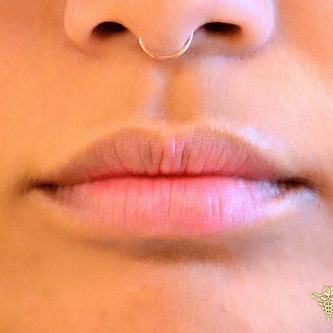 Lip Enhancement Natural look Before