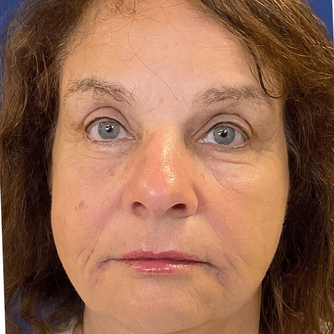 Jowls treated with fillers After