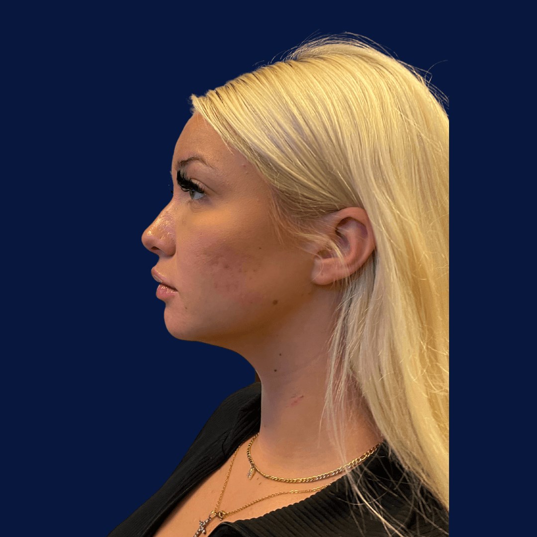 Chin Filler Augmentation Before