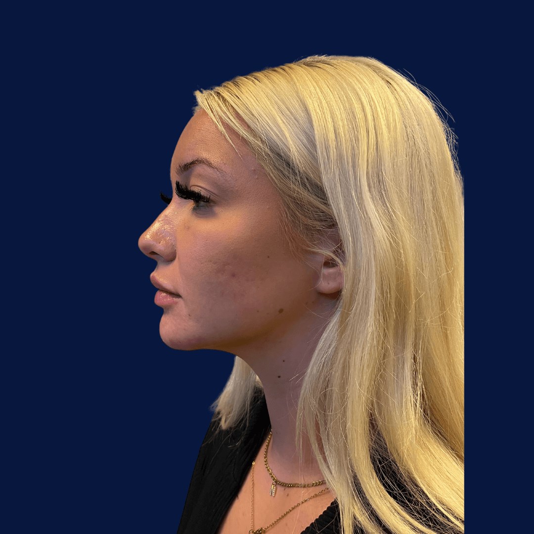 Chin Filler Augmentation After