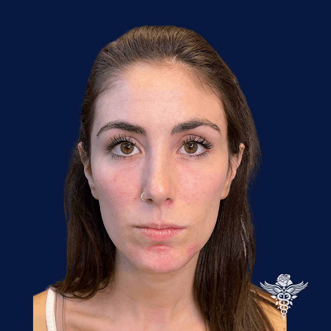 Mid Face Volume loss After