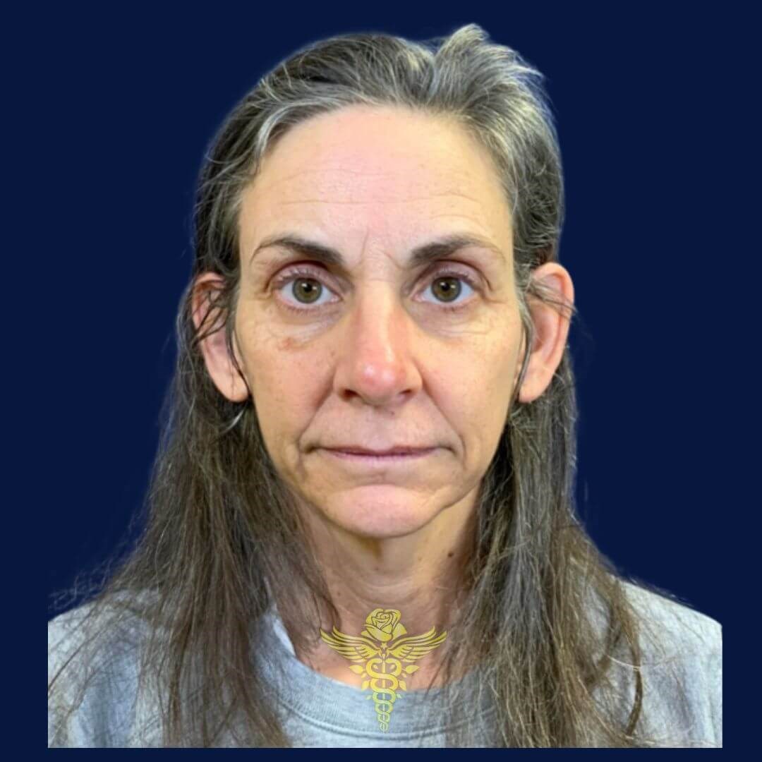 Full Face rejuvenation Before