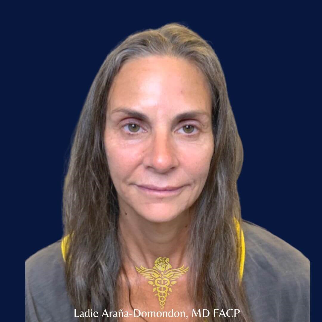 Full Face rejuvenation After